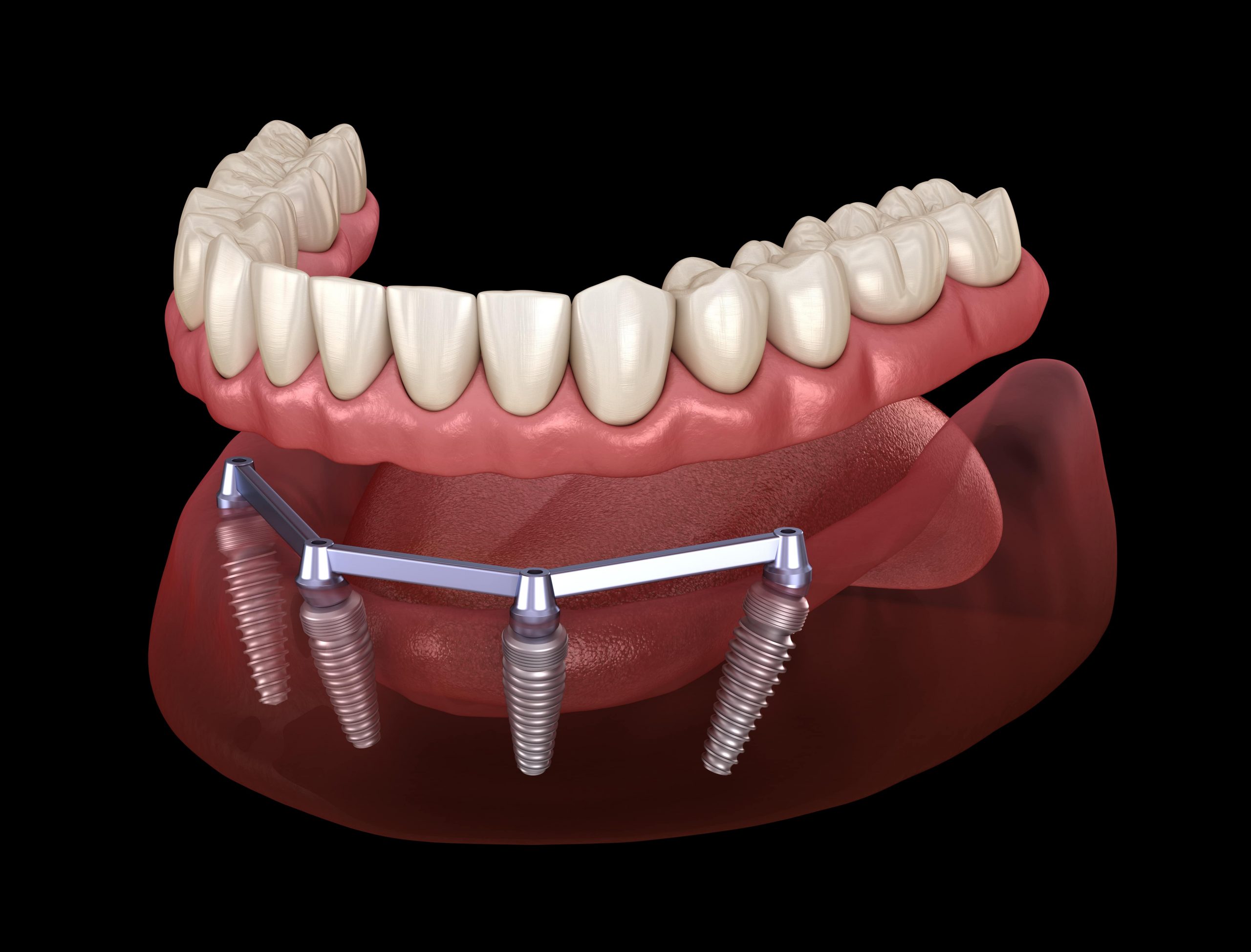 Long-Term Benefits of Dental Implants for London Residents